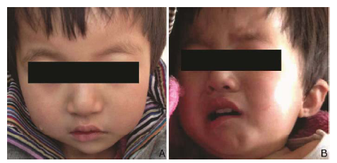 Asymmetric Crying Facies with Multiple Congenital Malformations a